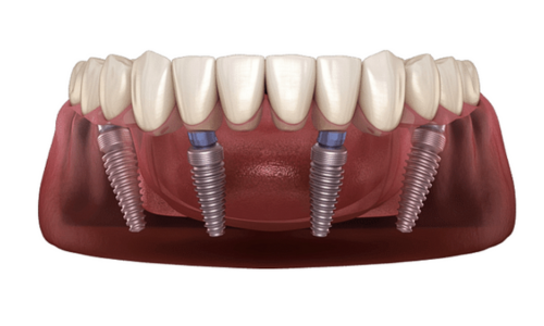 Ultimate Titanium Bridge-2